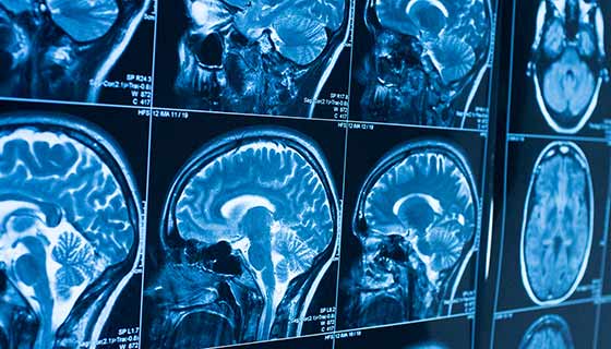 Brain Tumor CNN+PSO